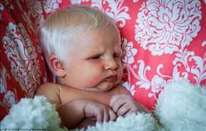 بالصور.. حالة نادرة تتسبب في ولادة طفلة بالشعر الأبيض