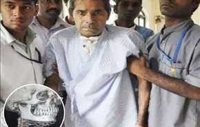 العثور على 150 دبوس غرزت في جسد رجل هندي دون ان يدري!