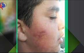 مستوطنون يعتدون على طفل بوحشية شمال نابلس