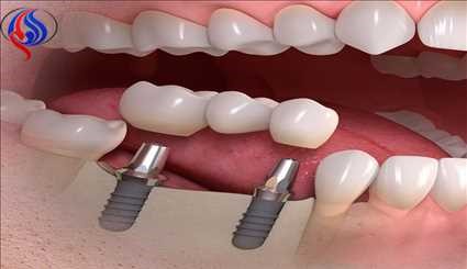 چگونگی ایمپلنت دندان+تصاویر