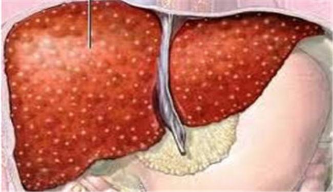 الكبد الدهني يزيد خطر الإصابة بمرض في القلب