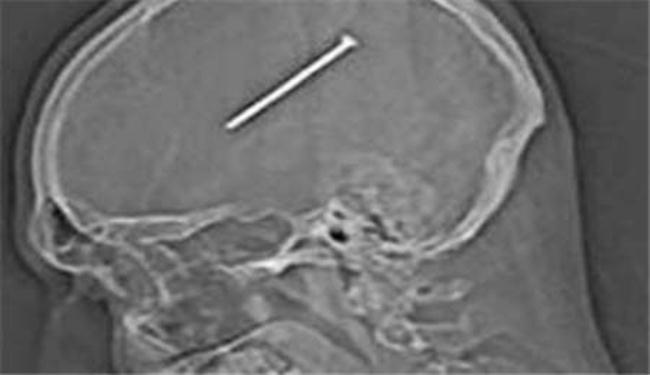 مسمار طوله 8 سم بدماغ رجل