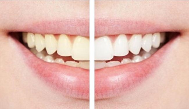 أغذية طبيعية تساعد في تبييض الأسنان