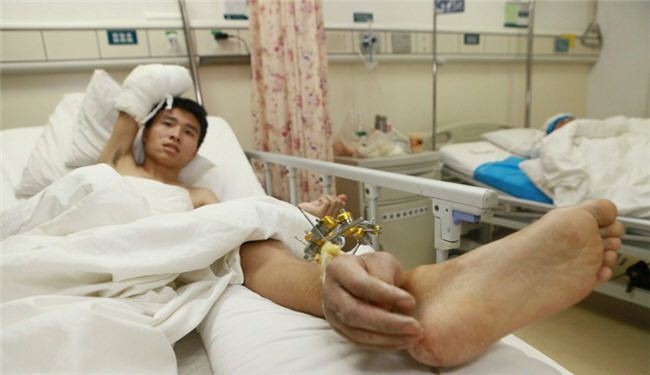 صيني يستيقظ ليجد يده مزروعة في ساقه