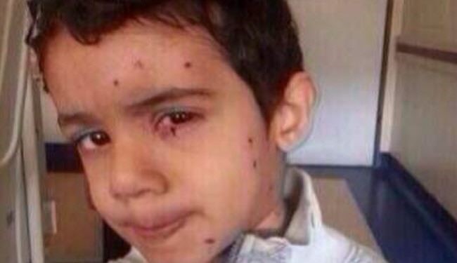 تصاویر؛ گلوله‌های ساچمه‌ای در صورت کودک بحرینی