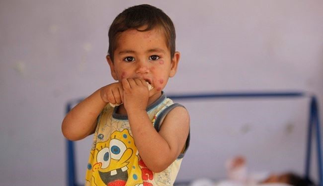 بیماری وحشتناک؛ ارمغان داعش برای کودکان سوری +عکس