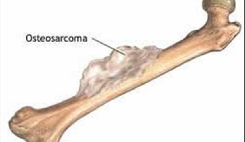 مراقب سرطان «سارکوما» باشید