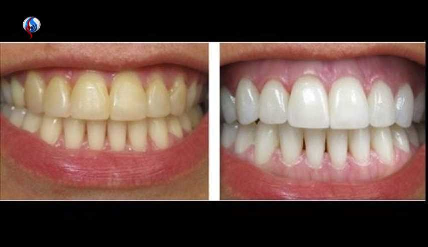 سفید کردن دندانها با روشی طبیعی