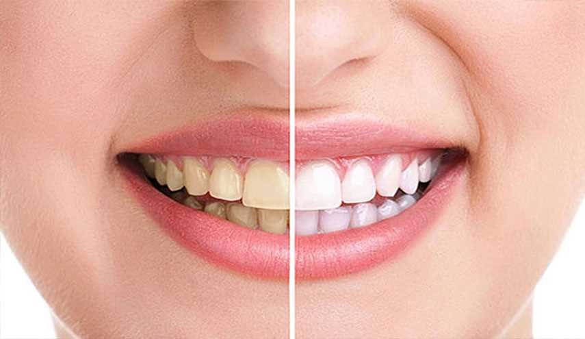 چهار روش طبیعی برای سفید کردن دندان ها