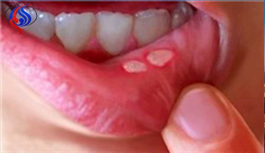 آفت دهان چگونه درمان می‌شود؟