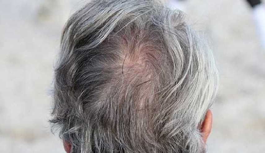 دراسة: شيب الشعر قد يكون علامة على هذا المرض..