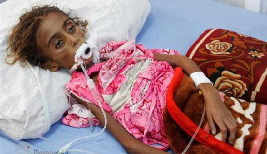 طفلة تموت في اليمن بسبب سوء في التغذية