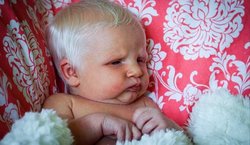 بالصور.. حالة نادرة تتسبب في ولادة طفلة بالشعر الأبيض