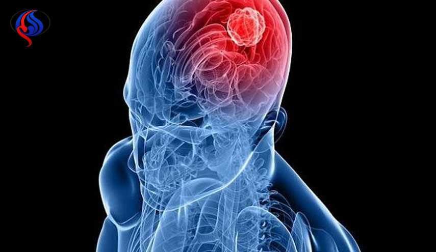تشخیص علائم اولیه سرطان مغز پنج سال قبل از بروز آن !