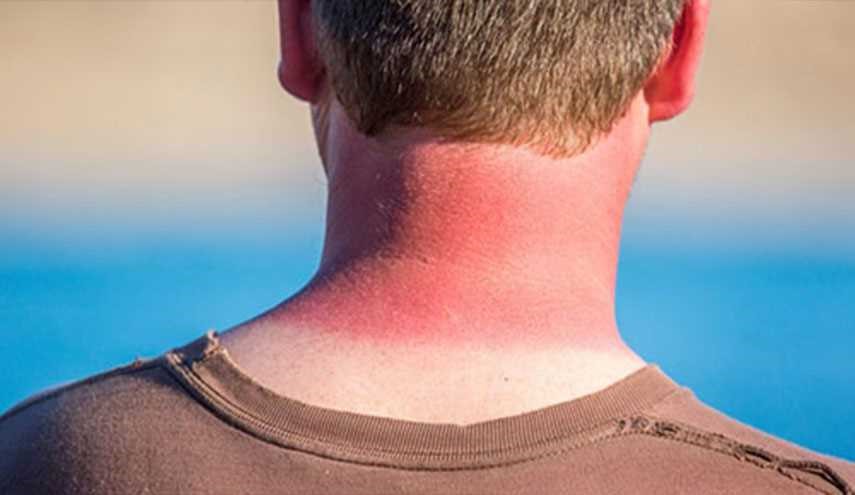 راهکارهای اورژانسی برای درمان آفتاب سوختگی