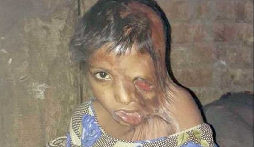طفلة ذاب وجهها بسبب والديها.. أخيرًا تلقى العلاج!