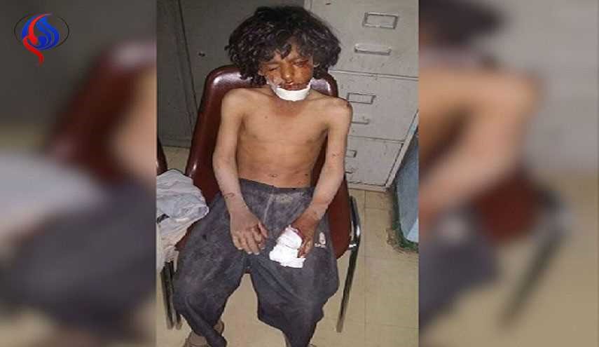 صورة مؤلمة لطفل اصيب جراء انفجار قنبلة عنقودية في الصفراء بصعدة