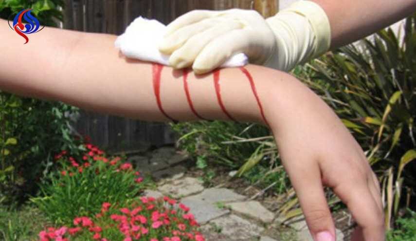 7 علاجات منزلية لتطهير الجروح ووقف النزيف بسرعة