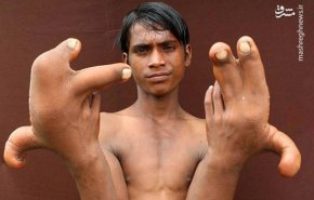 انگشتان غول پیکر یک هندی