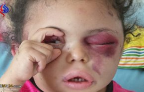 طوفان کاربران شبکه‌های اجتماعی برای "چشم بثینه"/ دختربچه یمنی که ۷ عضو خانواده‌اش شهید شدند + تصاویر