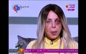 بالفيديو.. مذيعة مصرية تظهر بآثار  ضرب على وجهها!