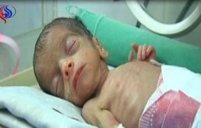 شاهد: الحصار يقتل 13400 يمني وطفل كل 10 دقائق