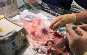 بالفيديو.. إنقاذ طفلة في بريطانيا ولدت وقلبها خارج جسدها