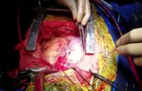 بالفيديو ... رجل يعيش بقلبين بعد عملية جراحية!!