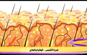 ضربة الشمس .. الوقاية والعلاج 