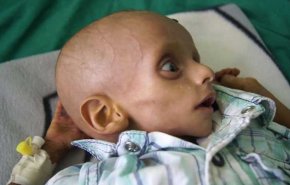 یک مقام سازمان ملل: توافقنامه سوئد حتی به یک کودک یمنی غذا نرسانده است