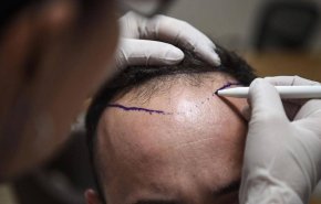 حادثة حيرت العلماء.. وفاة شخص في عملية زراعة شعر 