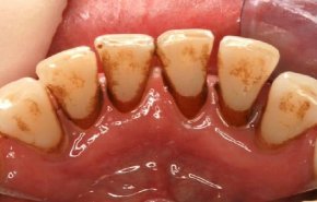 إليكم وصفة فعالة للتخلص من طبقة الجير التى ترهق الأسنان و اللثة!