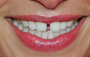 إزالة جير الأسنان.. 10 طرق طبيعية تجعلك اسنانك كاللآلئ