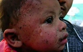 'حلیمه' نوزاد 9 ماهه؛ نماد جدید قربانیان عربستان سعودی در یمن + عکس