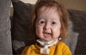 ’مرض بنجامين باتن’ يحول طفلة بعمر سنتين إلى ’جدة’