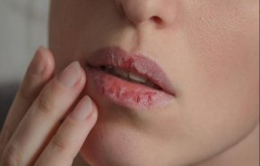 تشقق زوايا الفم مؤشر على الإصابة بالفطريات