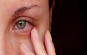 العيون الملتهبة من بين أهم أعراض 'كوفيد-19'