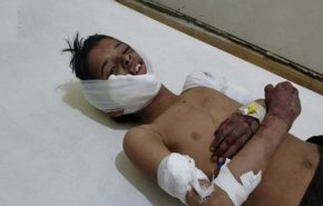 إصابة طفل يمني بانفجار قنبلة من مخلفات العدوان السعودي
