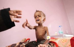 أرقام كارثية: 400 ألف طفل يمني يعانون من سوء التغذية الحاد 