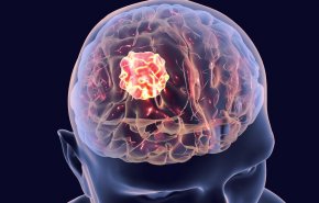  ما هي الأعراض الرئيسية لسرطان الدماغ؟