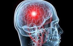  'نقاط ساخنة' في الدماغ تشير إلى علامات الإصابة بالسرطان