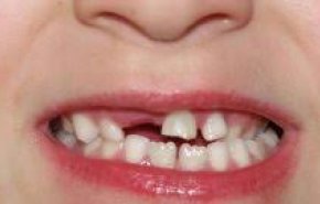تحذير..فقدان الاسنان يؤثر على قيامك بالمهام اليومية 
