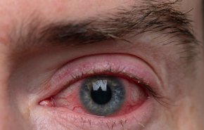 كيف يؤثر فيروس 'كوفيد-19' في جودة الرؤية
