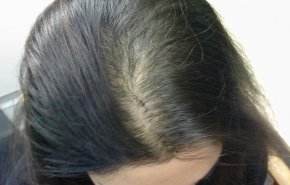 عوامل خطيرة وأقل شهرة لتساقط الشعر