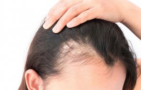 خبيرة تكشف عن طرق فعالة لوقف تساقط الشعر