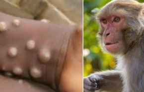 شناسایی اولین مورد ابتلا به «آبله میمون» در امارات