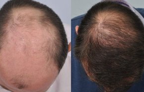 دواء جديد لاستعادة الشعر بالكامل لمن يعاني الصلع