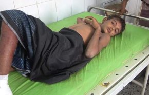 3956 شهيدا وجريحا ضحايا القنابل العنقودية منذ بداية العدوان على اليمن