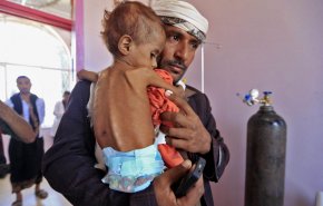 العدوان والحصار سبب رئيسي لسوء التغذية الحاد باليمن