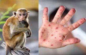 مصر تسجل أول حالة إصابة بجدري القرود